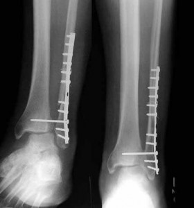 High Ankle Sprain - Syndesmosis Injury