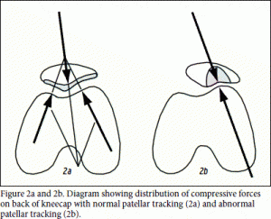 patellofemoral syndrome